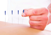 Kỹ thuật Châm cứu Cơ bản